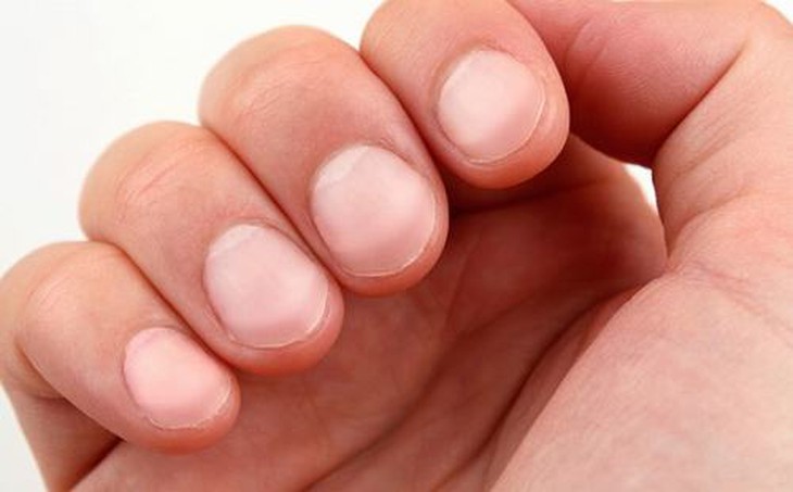 5 dấu hiệu trên móng tay có thể tiết lộ tình trạng sức khỏe của người nhiễm HIV- Ảnh 1.