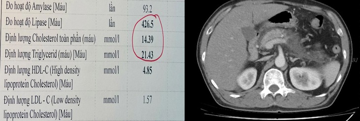 Cứu sống người đàn ông có chỉ số mỡ máu cao gấp 12 lần bình thường- Ảnh 2.
