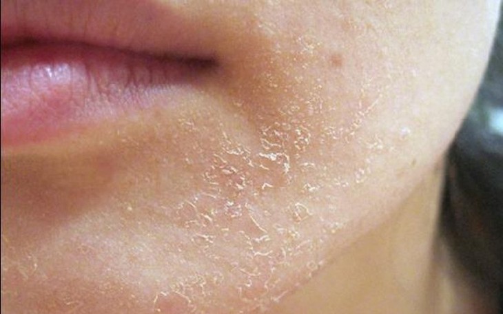 5 cách đơn giản tạm biệt khô da mùa hanh- Ảnh 1.