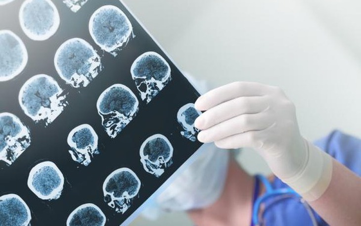 Người trẻ đối mặt với gánh nặng kép của đột quỵ não và sa sút trí tuệ- Ảnh 2. Người trẻ đối mặt với gánh nặng kép của đột quỵ não và sa sút trí tuệ- Ảnh 2.
