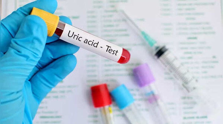 Dấu hiệu cảnh báo về axit uric cao và sỏi thận