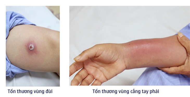 Cấy chỉ giảm đau xương khớp, người phụ nữ bị nhiễm trùng viêm mô bào- Ảnh 1.