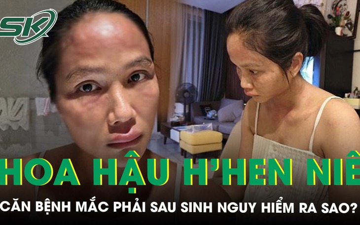 Căn bệnh mà Hoa hậu H"Hen Niê mắc phải sau sinh nguy hiểm ra sao? 