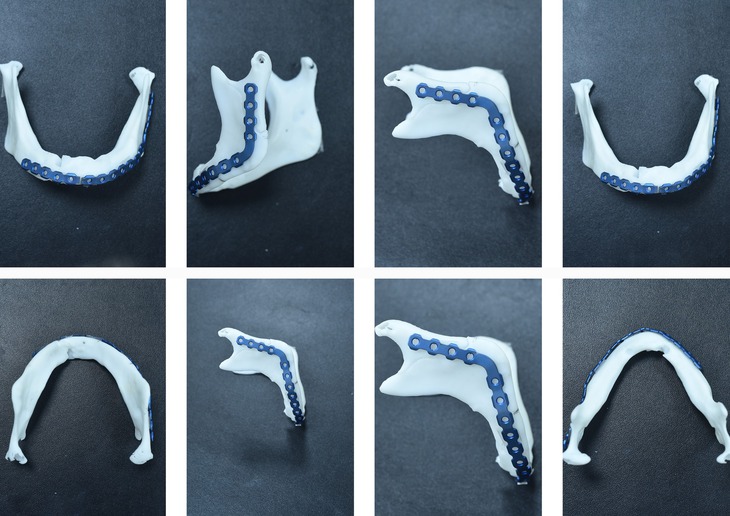 Ứng dụng công nghệ 3D trong tạo hình hàm mặt cho bệnh nhân mắc u não- Ảnh 3.