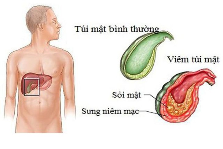 Dấu hiệu của viêm túi mật theo từng giai đoạn- Ảnh 1.