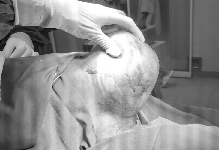 Khối u khổng lồ 1,5kg "mọc" trên vai người đàn ông 41 tuổi - Ảnh 1.