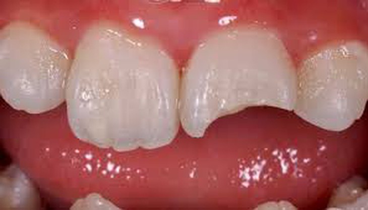 Xử trí chấn thương răng cửa như thế nào?- Ảnh 1.
