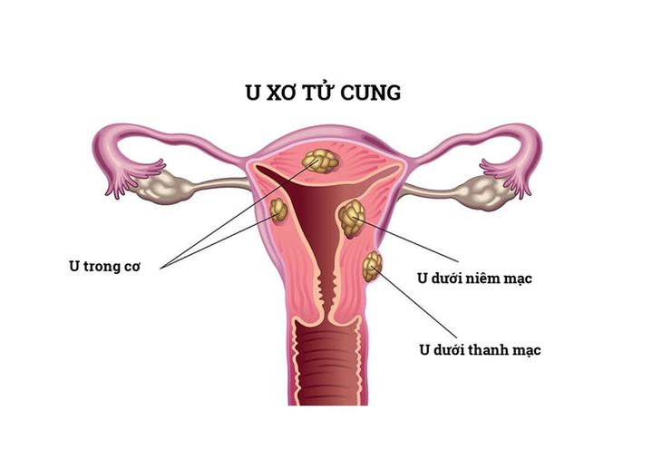 U xơ tử cung dưới thanh mạc có nguy hiểm không?- Ảnh 1.