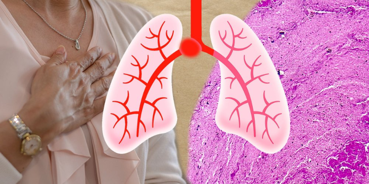 Thuyên tắc phổi ở người hút thuốc lá và những người có nguy cơ mắc căn bệnh nguy hiểm này- Ảnh 1.