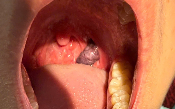 Bóc trọn khối u Lymphangioma sau phúc mạc cho bệnh nhân 25 tuổi- Ảnh 2.