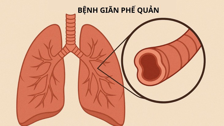 Ho ra máu cần cảnh giác với giãn phế quản- Ảnh 1.