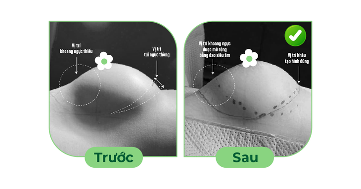 Tháo túi ngực và thay túi ngực: Phương pháp gây mê, kỹ thuật phẫu tích, hồi phục- Ảnh 1. Tháo túi ngực và thay túi ngực: Phương pháp gây mê, kỹ thuật phẫu tích, hồi phục- Ảnh 1.
