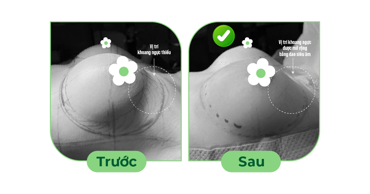Tháo túi ngực và thay túi ngực: Phương pháp gây mê, kỹ thuật phẫu tích, hồi phục- Ảnh 2. Tháo túi ngực và thay túi ngực: Phương pháp gây mê, kỹ thuật phẫu tích, hồi phục- Ảnh 2.