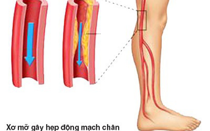 Bệnh động mạch chi dưới ở người cao tuổi dễ nặng lên vào mùa lạnh