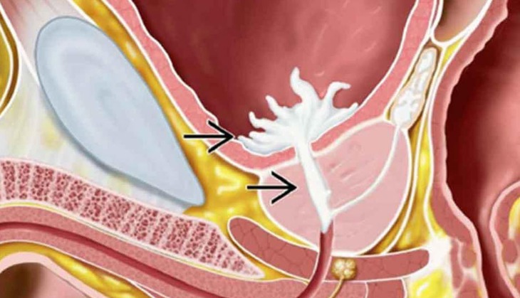 Không thấy tinh dịch sau quan hệ cảnh báo xuất tinh ngược- Ảnh 1.