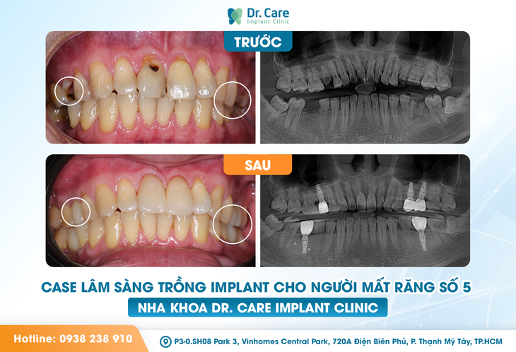 Trồng răng số 5 giá bao nhiêu - lựa chọn trồng răng Implant sao cho đúng?- Ảnh 1.
