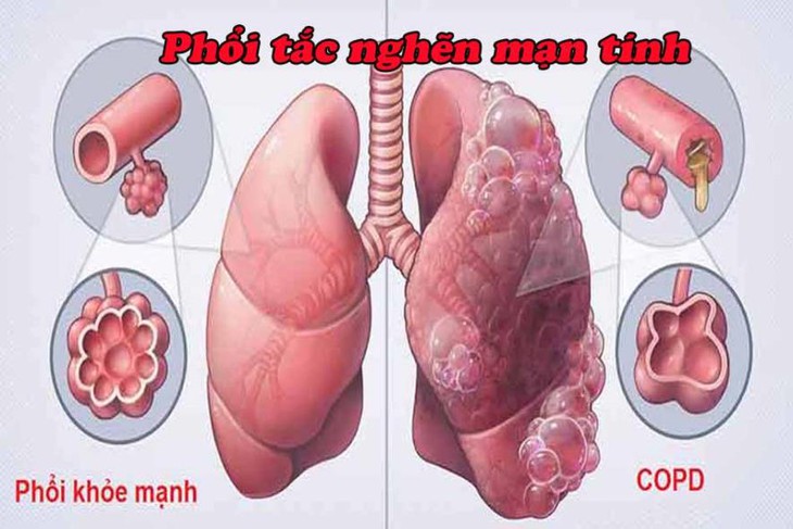 Nhận biết bệnh phổi tắc nghẽn mạn tính- Ảnh 1. Nhận biết bệnh phổi tắc nghẽn mạn tính- Ảnh 1.