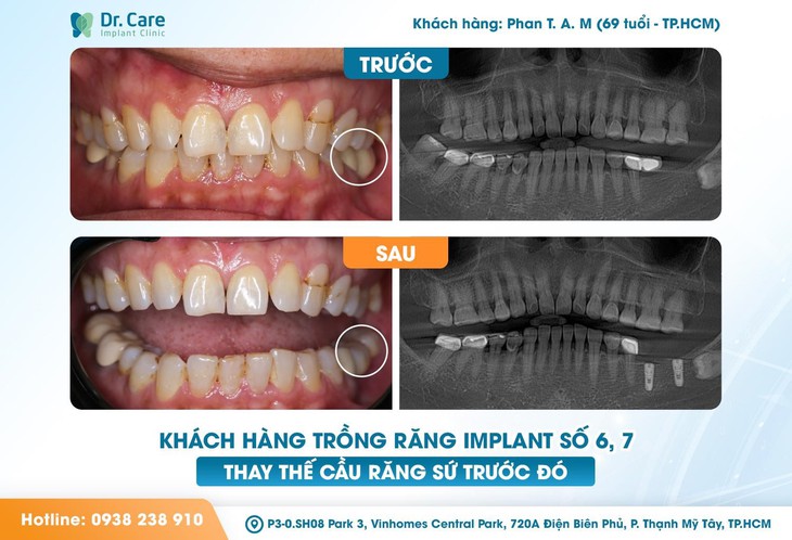 Mất răng số 7 và hậu quả khó lường! Trồng răng Implant số 7 giá bao nhiêu?- Ảnh 3. Mất răng số 7 và hậu quả khó lường! Trồng răng Implant số 7 giá bao nhiêu?- Ảnh 3.
