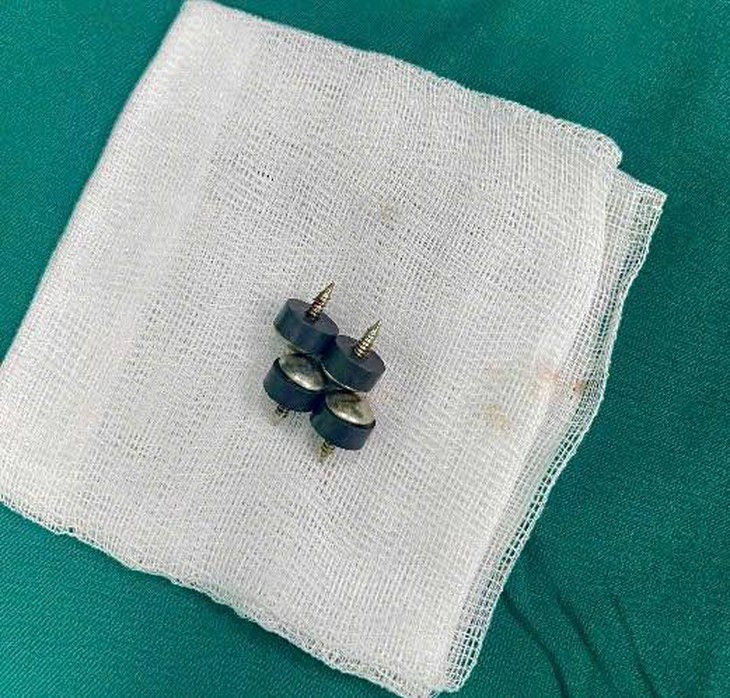 Bé trai nuốt 4 viên đinh nam châm đầu nhọn nguy hiểm
- Ảnh 2.