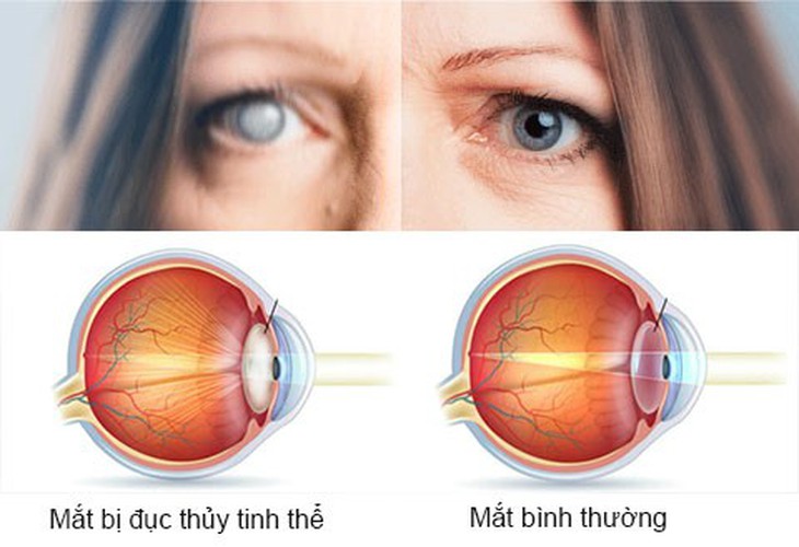 Cách phòng tránh các bệnh mắt thường gặp ở người tiểu đường- Ảnh 1.