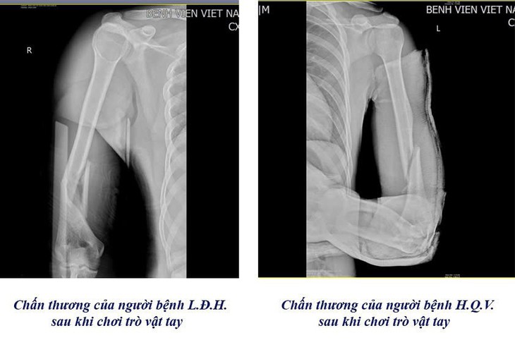 Cảnh báo nguy cơ gẫy xương cánh tay từ trò vật tay- Ảnh 1. Cảnh báo nguy cơ gẫy xương cánh tay từ trò vật tay- Ảnh 1.