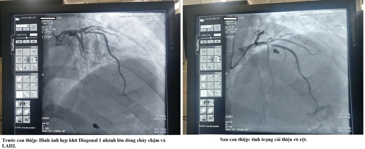 Hồi sinh sự sống cho cụ ông 70 tuổi bị nhồi máu cơ tim cấp trong đêm- Ảnh 1. Hồi sinh sự sống cho cụ ông 70 tuổi bị nhồi máu cơ tim cấp trong đêm- Ảnh 1.