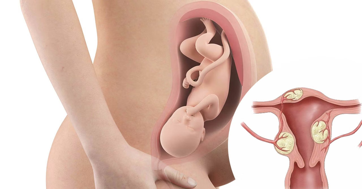 U xơ tử cung có ảnh hưởng đến sinh sản không?- Ảnh 1.