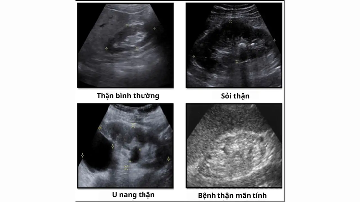 Suy thận siêu âm có ra không? Tìm hiểu ngay để biết!- Ảnh 2.