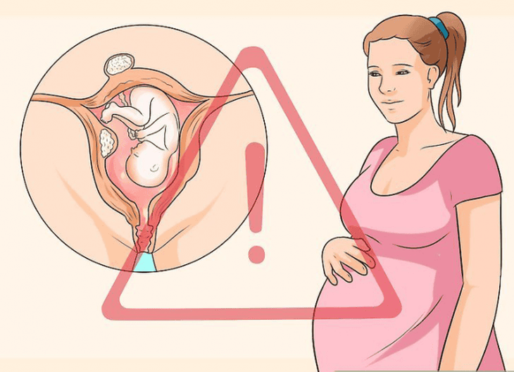 U xơ tử cung có ảnh hưởng đến sinh sản không?- Ảnh 2.
