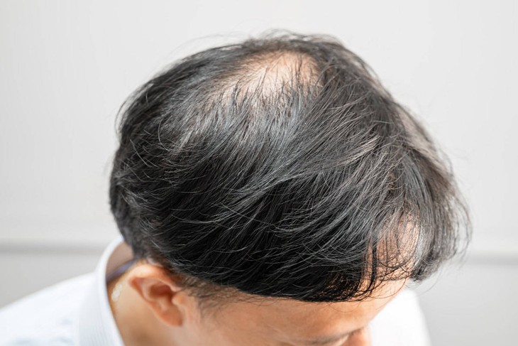 Rụng tóc nhiều vào mùa đông: Bác sĩ chỉ 3 sai lầm khi gội sấy và 4 cách khắc phục- Ảnh 1.