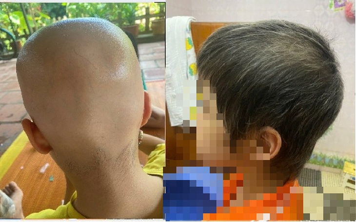 Vi phẫu hồi sinh cánh tay liệt sau tai nạn giao thông- Ảnh 1.
