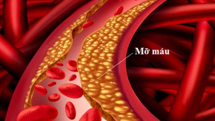 Chế độ ăn loại bỏ ‘mỡ máu xấu’ bảo vệ thành mạch, ngừa đột quỵ- Ảnh 1. Chế độ ăn loại bỏ ‘mỡ máu xấu’ bảo vệ thành mạch, ngừa đột quỵ- Ảnh 1.