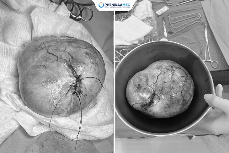 Phenikaa phẫu thuật thành công cho bé gái 9 tuổi mắc u quái buồng trứng 20 cm, bảo toàn khả năng sinh sản- Ảnh 2.