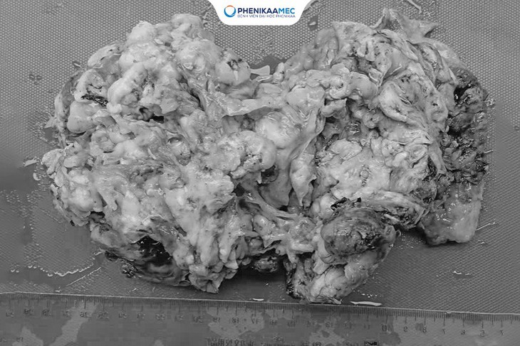 Phenikaa phẫu thuật thành công cho bé gái 9 tuổi mắc u quái buồng trứng 20 cm, bảo toàn khả năng sinh sản- Ảnh 3.