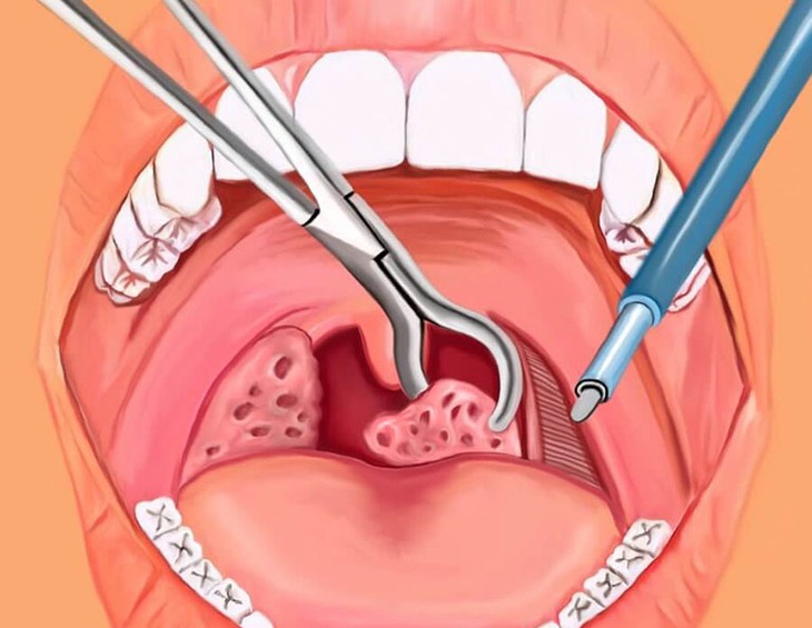 Cắt amidan là một giải pháp ngoại khoa mang lại hiệu quả cao để chấm dứt tình trạng viêm nhiễm mạn tính và biến chứng.