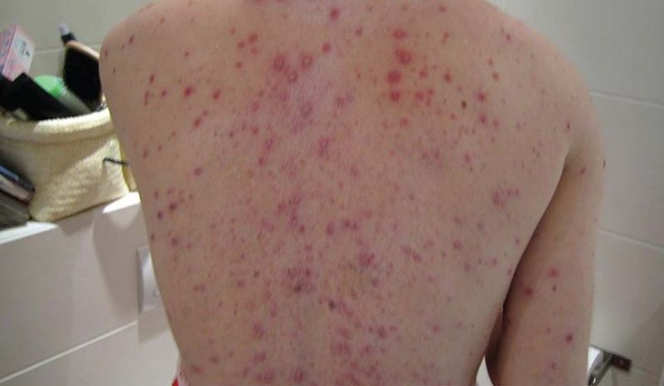 Nguy cơ biến chứng thủy đậu từ việc dùng thuốc sai cách- Ảnh 1.