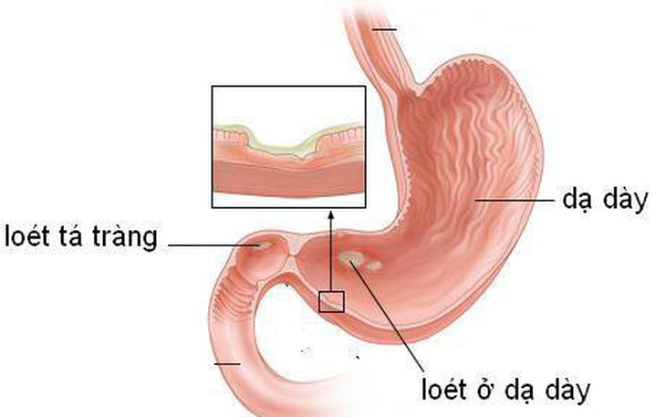 6 dấu hiệu cảnh báo ung thư dạ dày cần biết- Ảnh 1.