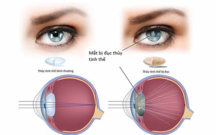 Đục thủy tinh thể ở người trẻ: Những yếu tố làm tăng nguy cơ- Ảnh 1.