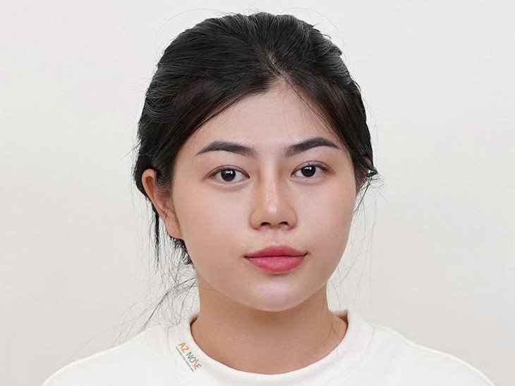 Vì sao nhiều người cần tái tạo mũi hỏng chỉ sau 1-2 năm?- Ảnh 1.