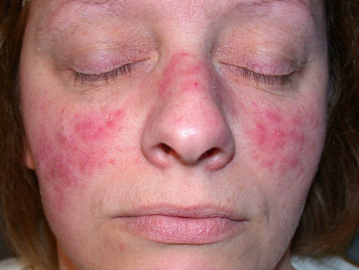 Biến chứng nguy hiểm của lupus ban đỏ hệ thống- Ảnh 1.