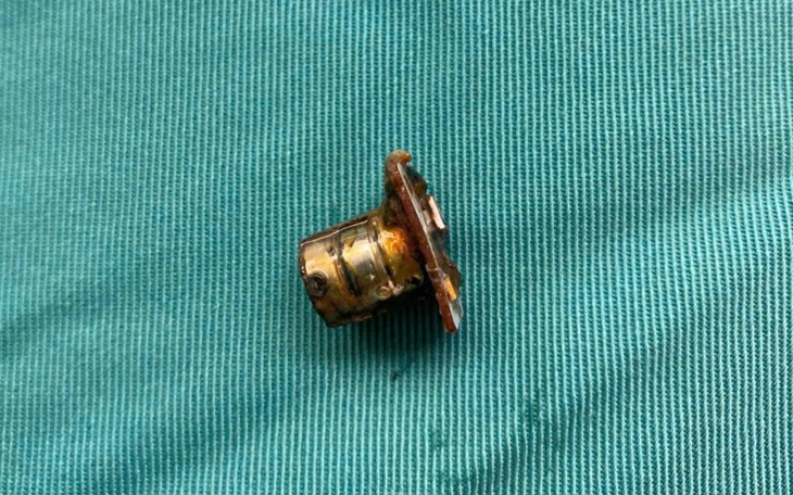 Nuốt pin cúc áo, bé 2 tuổi bỏng nặng thực quản- Ảnh 3.