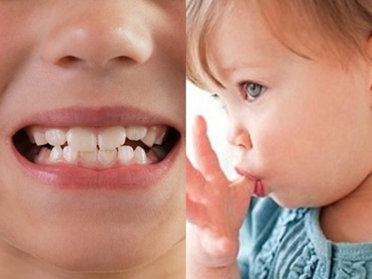 Điều trị sớm khớp cắn ngược răng sữa ở trẻ- Ảnh 1. Điều trị sớm khớp cắn ngược răng sữa ở trẻ- Ảnh 1.