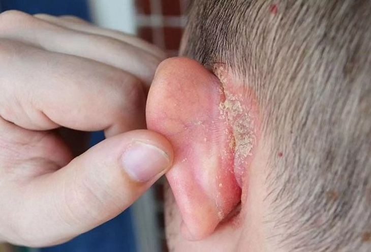 Vành tai đỏ, ngứa, khô da và bong tróc cảnh giác với bệnh chàm tai- Ảnh 1.
