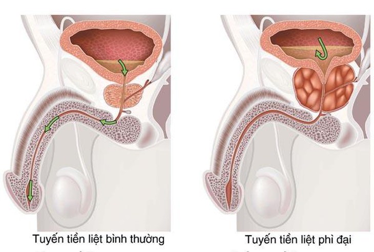 Phì đại tuyến tiền liệt lành tính khi nào nguy hại?- Ảnh 1.