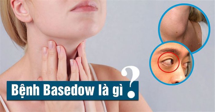 Khi bị basedow có phải kiêng iod không?- Ảnh 1. Khi bị basedow có phải kiêng iod không?- Ảnh 1.