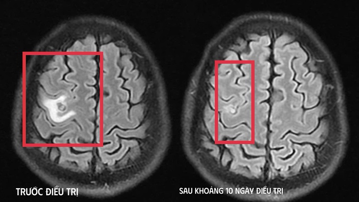 Sán dây chó làm tổ trong não suýt nhầm với u não- Ảnh 2.