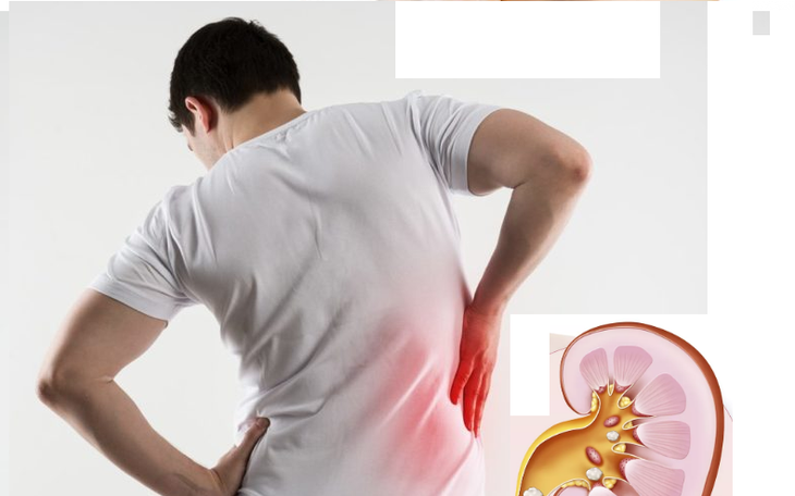 Sỏi tiết niệu ở trẻ: Phát hiện muộn có thể ảnh hưởng chức năng thận- Ảnh 1.