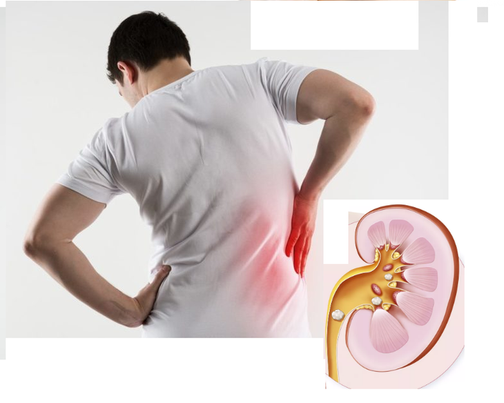 Sỏi tiết niệu có thể gây ra những hậu quả gì?- Ảnh 1.