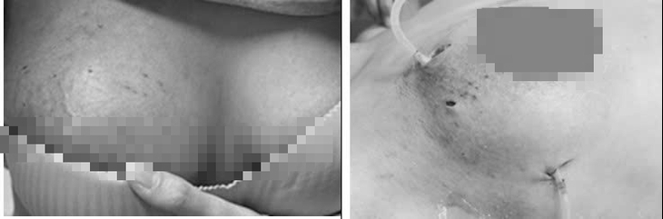 Nâng ngực đón Tết, người phụ nữ biến dạng bầu vú- Ảnh 1.