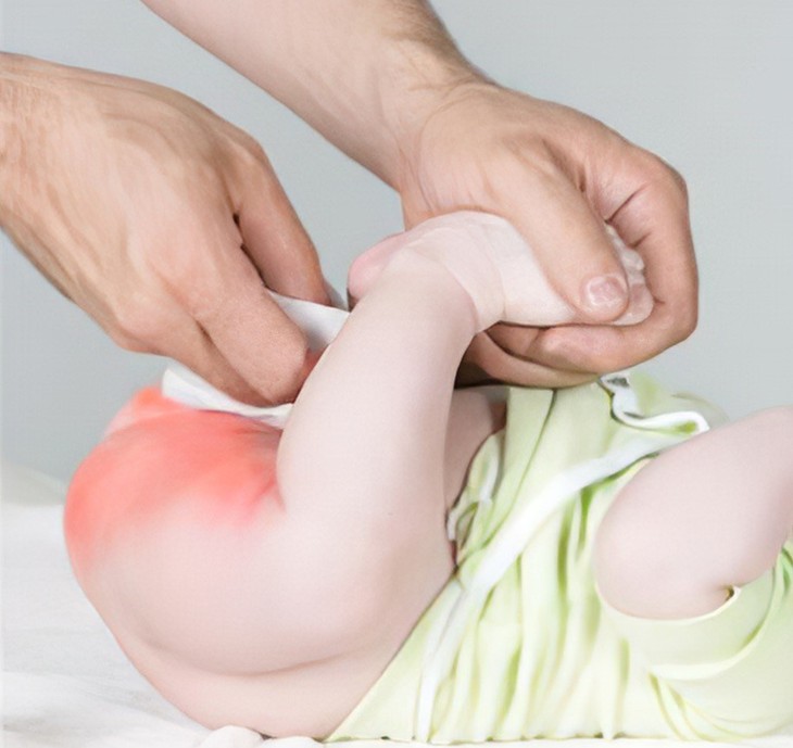 Hăm tã ở trẻ nhỏ: Mẹ cần xử lý thế nào?- Ảnh 1. Hăm tã ở trẻ nhỏ: Mẹ cần xử lý thế nào?- Ảnh 1.
